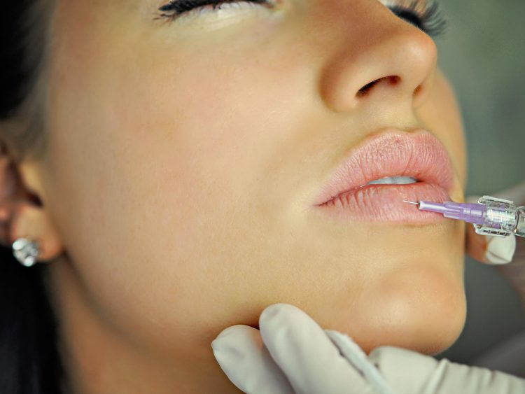 NU'CLINIC-Výplň pier kyselinou hyalurónovou